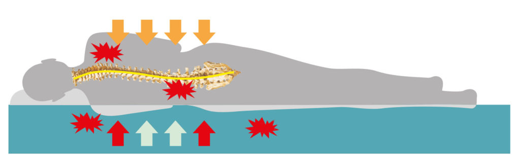 Körper liegt auf zu harter Matratze, sodass die Wirbelsäule falsch belastet wird und Rückenprobleme entstehen.