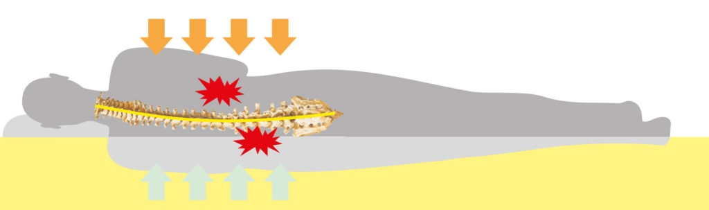 Körper liegt auf zu weicher Matratze, sodass die Wirbelsäule falsch belastet wird und Rückenschmerzen entstehen.